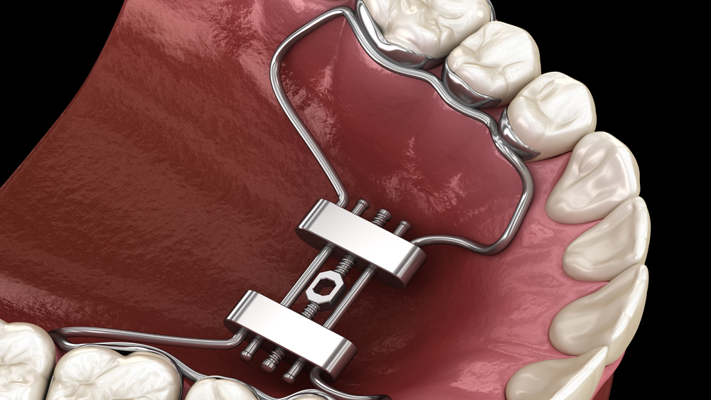 black dental model of the jaw with a bridge prosthesis and zirco